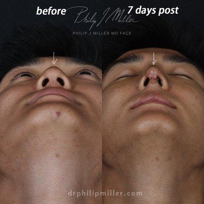 Rhinoplasty, 7 days post.