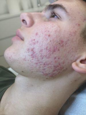 Acne before FaceReality Bootcamp