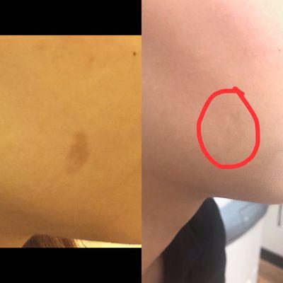 Birth Mark used intense pulse light( IpL) results after four treatments.