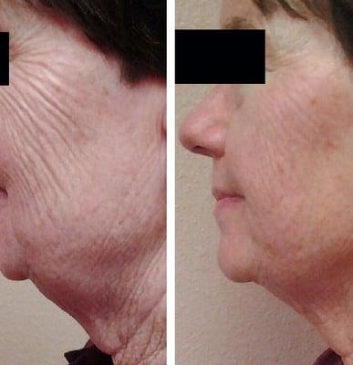 Facial/neck and chin for fat pockets, fine lines, and wrinkles.