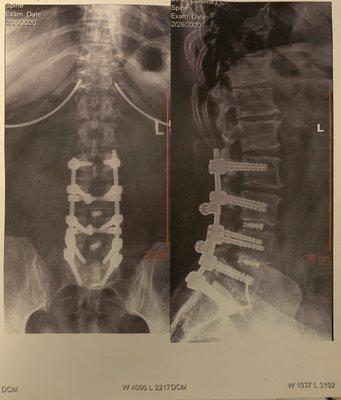 Lumbar fusion S1-L2