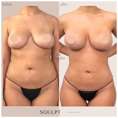 Fat Transfer Breasts (Silicone Free Zone™, 800 cc/side) + SoftSqulpt™ awake liposuction to abdomen, waist & hips, back bra roll, lower back