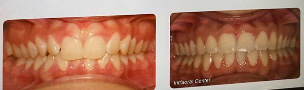 before and after of my teeth