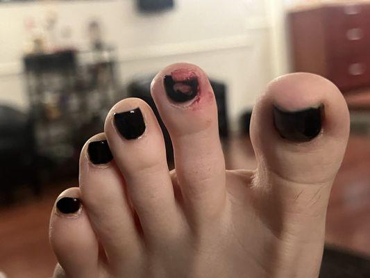 Ripped nail bed