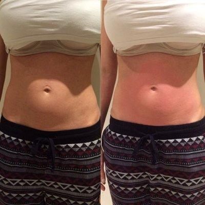 CryoSlimming- Female before and after