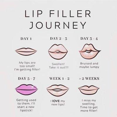 Lip Filler using Juvederm Ultra XC or Juvederm Volbella