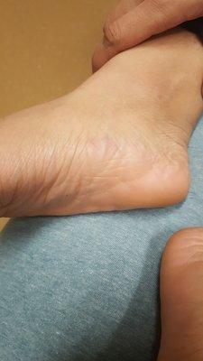 Damaged muscles in the foot