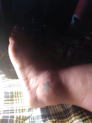 Bug bites from last night. My whole ankle is swollen now!!!