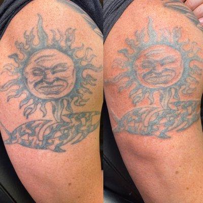 Alkaline Tattoo Removal