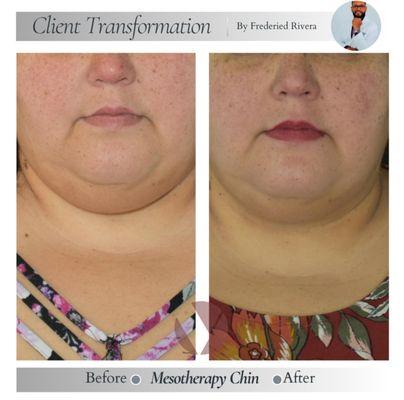 Customer-Mesotherapy applied-Consent to public picture obtained.