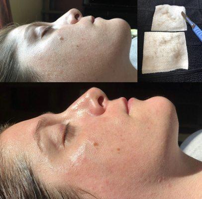 Dermaplaning facial