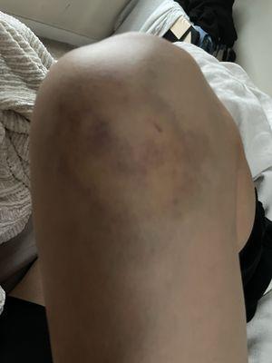 Picture of my knee , weeks after I was Tackled and assaulted and bit . Never have I ever felt so violated