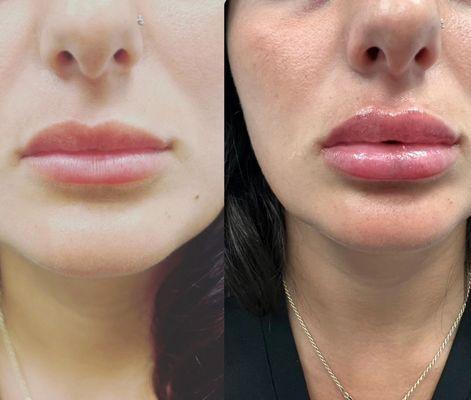 Lip Filler with Revanesse LIPS+ (1.2 syringe injected into lips)