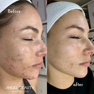 Holistic Acne treatment for teens and adults. Also we offer Jet plasma and Microchanneling to enhance results and treat acne scars.