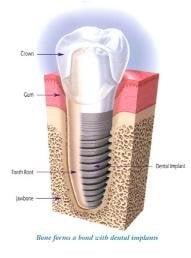 Dental implants