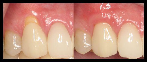 Easy Gum Graft treatment in our office