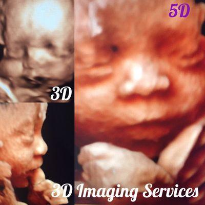 3D Ultrasound vs 5D ultrasound...