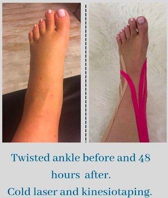 Sprained ankle before and after treatment 48 hours later.