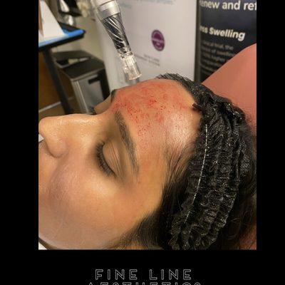 Fine Line Aesthetics
#finelineluciouslips
#prpmicroneedling