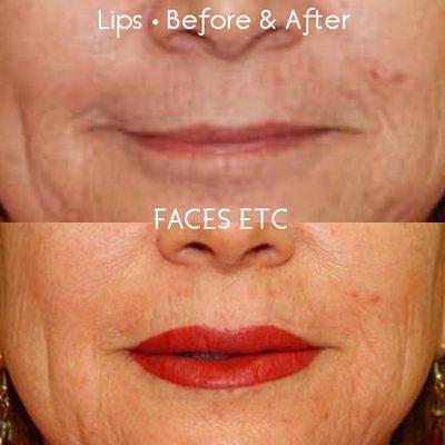 Lips - Before &After