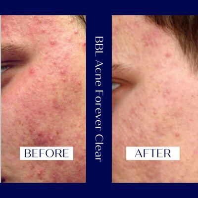 BBL Acne Forever Clear Before & After.