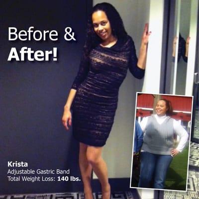 Krista lost 140 lbs. after having the Adjustable Gastric Band with Dr. Srikanth.