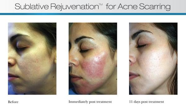 Acne Scar Laser Treatment: Stimulate collagen to fill in dips and crevices for smoother skin. 4-6 sessions, minimal downtime