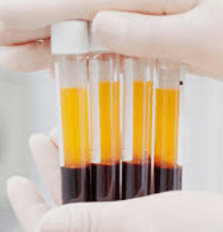 Platelet Rich Plasma (PRP)