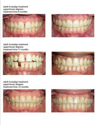 adult Invisalign treatment