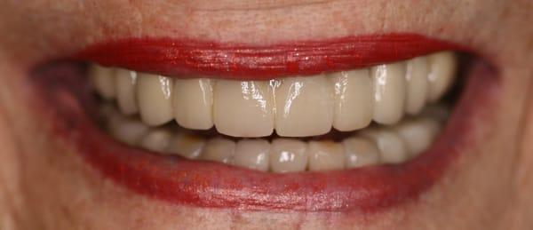 AFTER - NEW 'PORCELAIN VENEERS' AND CROWNS