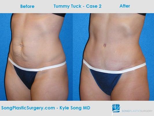 Tummy Tuck before & after: goal was to get rid of excess skin & lower abdomen bulge.