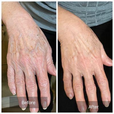 Hand treatment with Plant based Stem-cell & Exosome. $50/treatment.