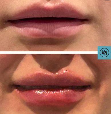 Lip filler injections.  Get that pouty lip look.