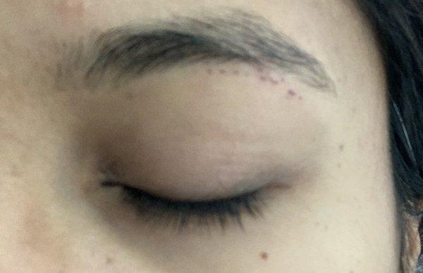 Cuts under my brow from the thread