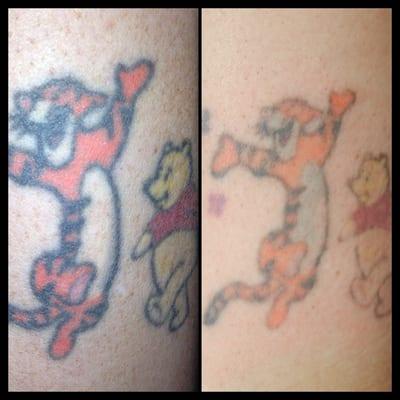 "The only tattoo that moms like" after two treatments at Erased.