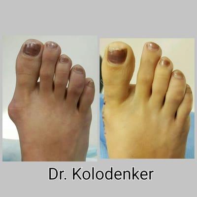 Before and after bunion surgery in Newport Beach