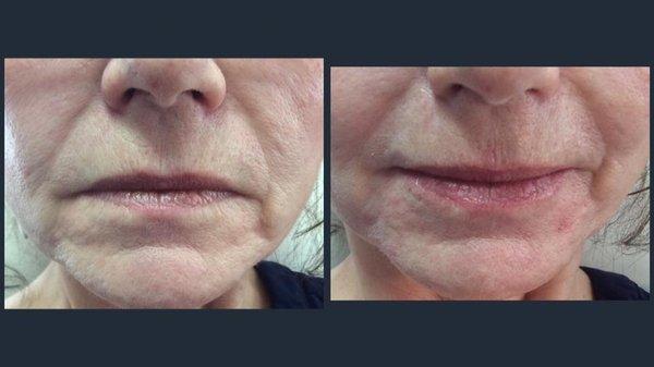 Lower face filler before and after