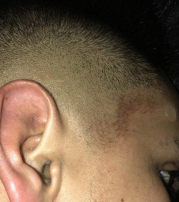 Rash Given by barber