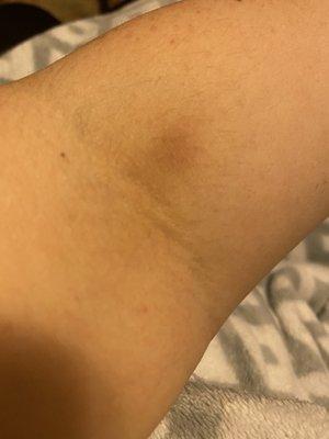 Bruise from blood draw after tech was digging the needle under my skin.