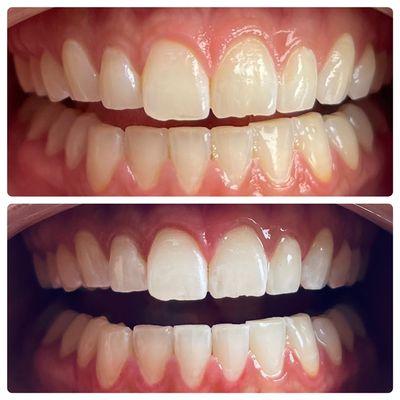 Teeth whitening with LED light.