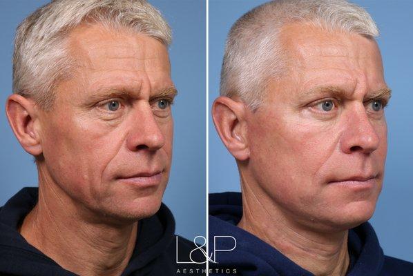 Male Facelift & Neck Lift