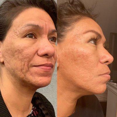 Before and after two sessions of microneedling scar removal