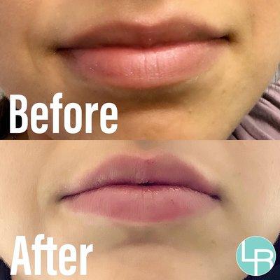 Lip filler