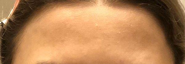 Smooth forehead after botox