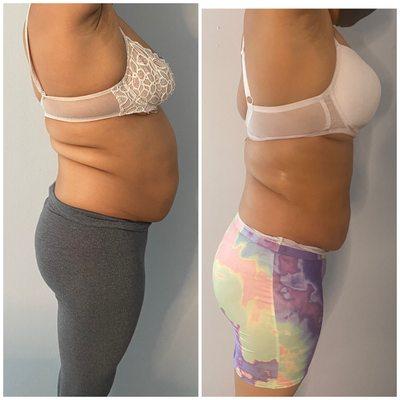 4 sessions of 360 Body Sculpting treatments