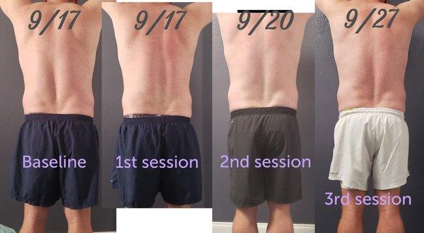 Cavitation (fat reduction) - male client 3 sessions