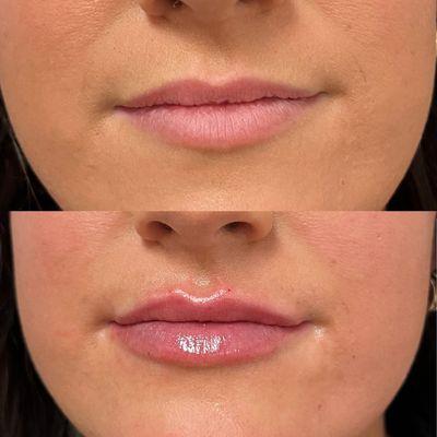 before and after Juvederm Ultra Plus