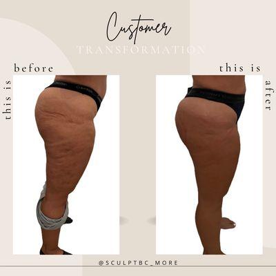 Cellulite treatment