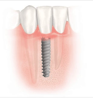 James C. Melillo, DDS Dennise M. Munoz, DDS Maria D. Salva, DMD General, Cosmetic and Implant Dentistry Yonkers, NY 10704