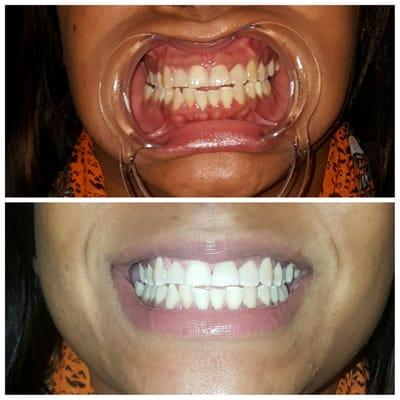 Loving my new smile + Zeneyda is such a nice person, it was a pleasure metting you.Thanks to CLS for my results.